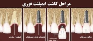 مراحل ایمپلنت فوری